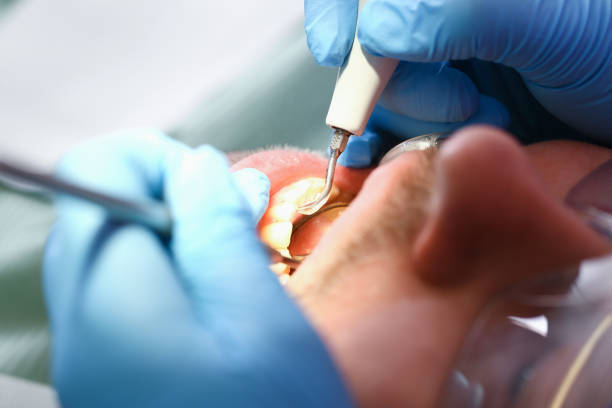 Best Emergency Dental Extractions in Irvine, CA